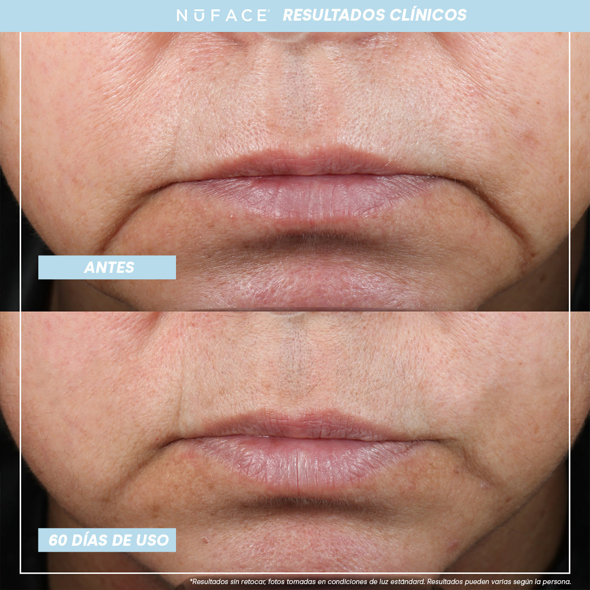 NuFACE TRINITY +® Kit de inicio